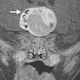 Illustration for article titled Horrifying Tumor With Teeth Removed from Newborn Babys Brain